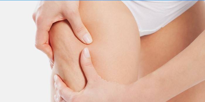 Cellulite an den Beinen