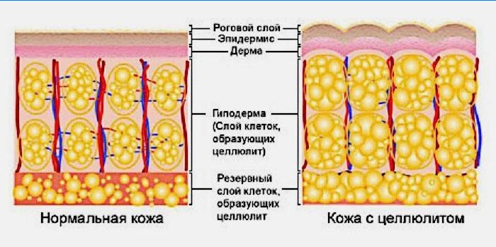 Was ist Cellulite?