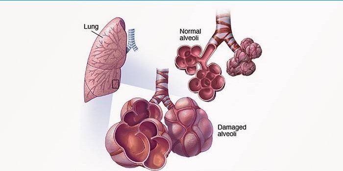 Exogene allergische Alveolitis