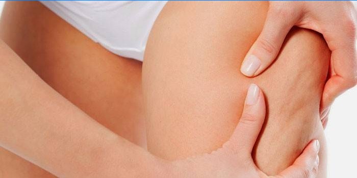 Cellulite in den Hüften einer Frau