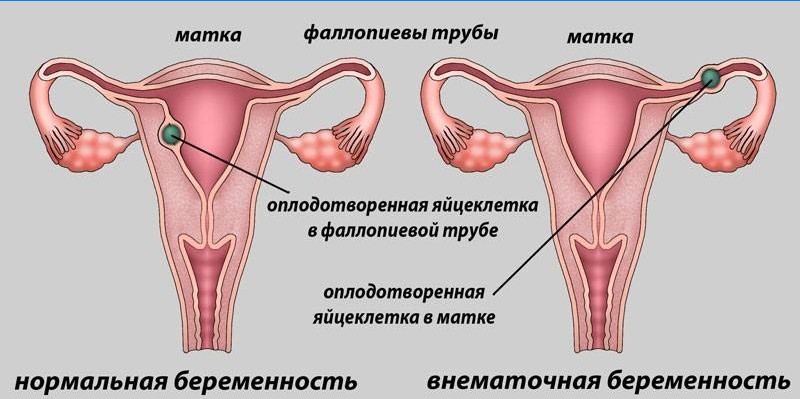 Normale und Eileiterschwangerschaft