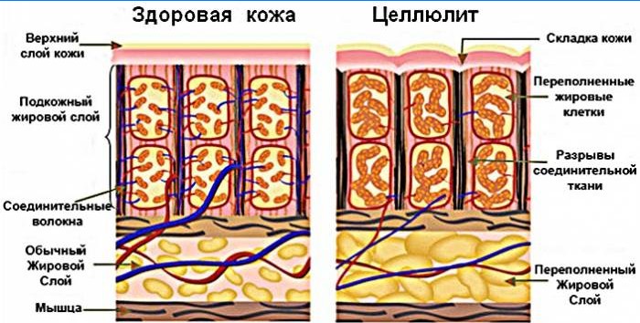 Cellulite auf dem Schema