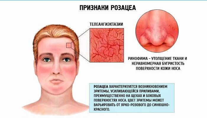 Zeichen von Rosacea